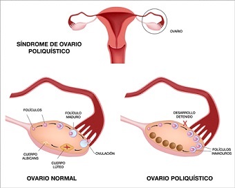 Esquema Ovario poliquístico